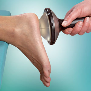 shockwave plantar fasciitis